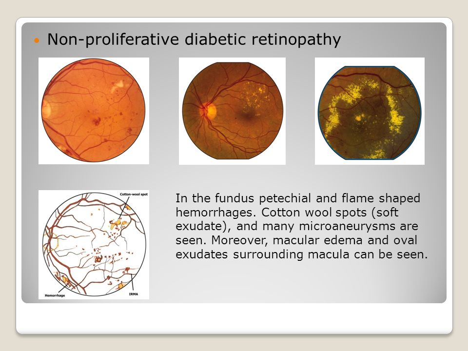 hipertónia retinopathia magas vérnyomás kezelése szoptató nőknél